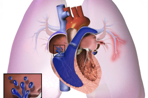 An image depicting pulmonary hypertension