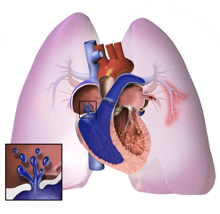An image depicting pulmonary hypertension